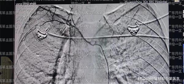 食道肿瘤有什么好的治疗方法吗广东药科大学广州复星禅诚医院肿(图1)