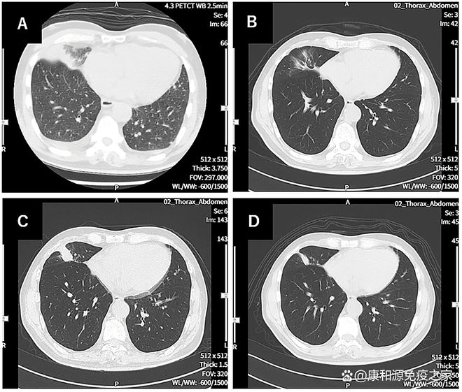2年未复发！哪些癌症适合树突状细胞DC疫苗？肿瘤患者迎来新生机(图4)