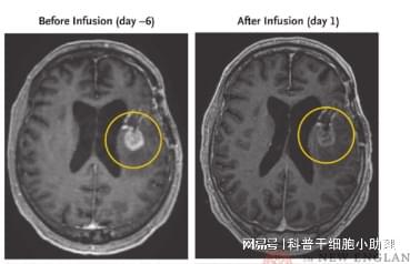 人体的免疫细胞如何与肿瘤细胞展开激烈对抗？(图5)