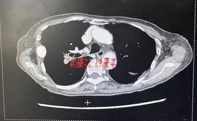MET新例量3个月达到PR！赛沃替尼+EGFR-TKI助力EGFR突变伴原发MET扩增患者快速缓解且长期获益(图3)