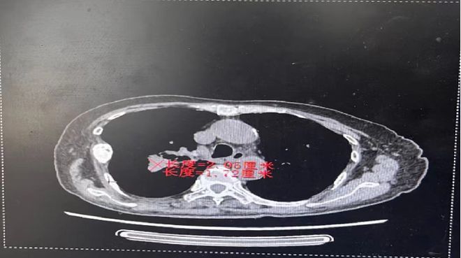 MET新例量3个月达到PR！赛沃替尼+EGFR-TKI助力EGFR突变伴原发MET扩增患者快速缓解且长期获益(图2)