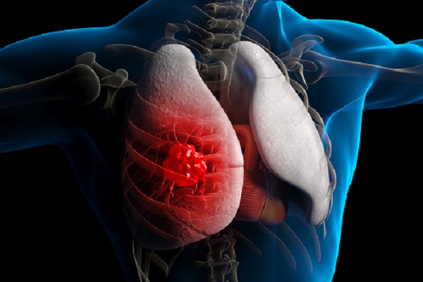 肺癌患者还能买防癌险吗？2024肺部肿瘤复发险怎么买？(图1)