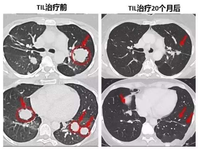 借助TIL疗法存活超10年！国内TIL细胞冲击宫颈癌、肺癌、骨肉瘤(图3)