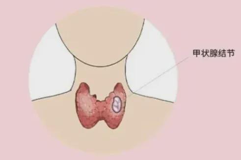 切除甲状腺对身体有影响吗？医生：要做好术后生活管理(图2)