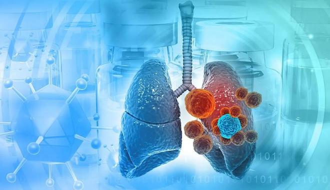 陈利娟教授：有亲属得肺癌自己是不是也无法避免？(图1)