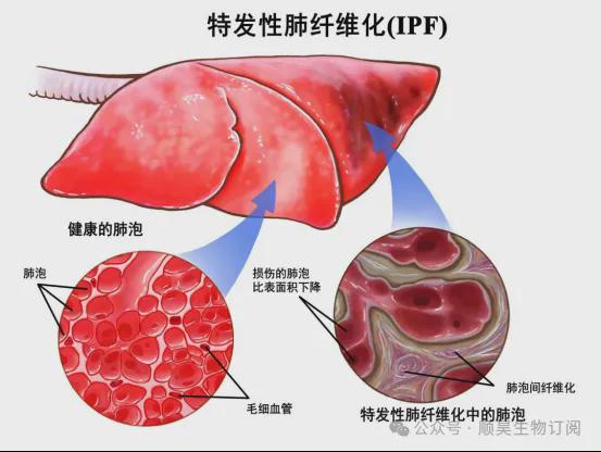 自体干细胞移植助力肺纤维化患者重获新生开年实现突破！(图2)