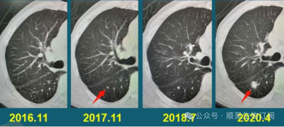 连续回输3次NK免疫细胞肺部结节竟神奇消失！(图2)