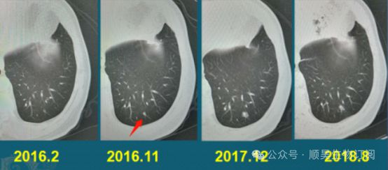 连续回输3次NK免疫细胞肺部结节竟神奇消失！(图3)