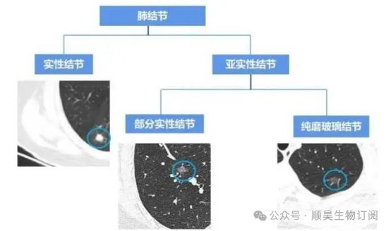 连续回输3次NK免疫细胞肺部结节竟神奇消失！(图1)