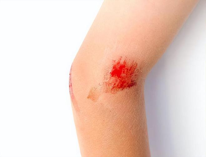 沾染乙肝患者的血液就会传染吗？(图2)