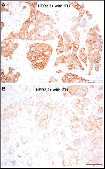 HER2+乳腺癌的多样性：肿瘤内异质性、低水平HER2基因扩增及其对新辅助治疗反应的影响(图1)