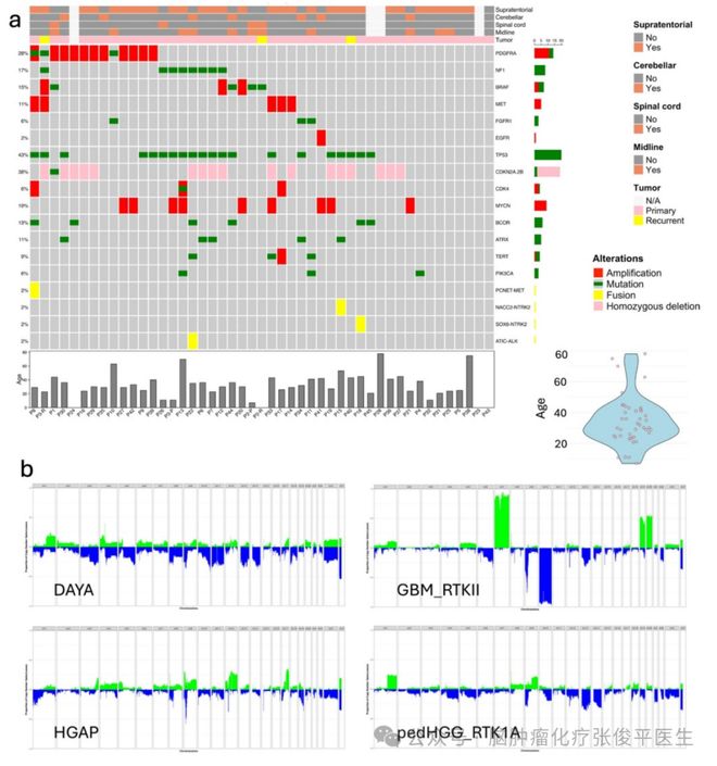 常伴有MAPK通路改变的青少年和年轻成人型弥漫性星形细胞瘤(图2)