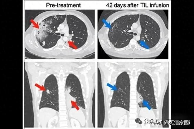 控制率72%！TILs疗法精准狙击无基因突变肺癌最快2027年上市(图1)