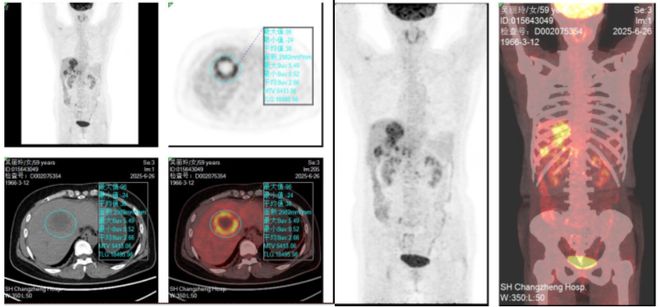 MTB探讨：HER2阳性晚期肝内胆管癌治疗策略｜第45轮长征疑难肿瘤MTB会议(图2)