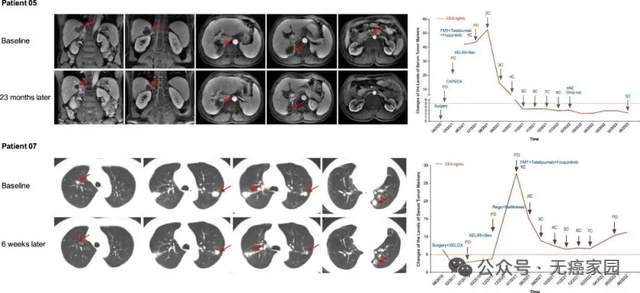 95%有效率！国研三联疗法登顶《柳叶刀》破解晚期肠癌困局！(图3)