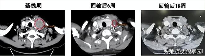 370万天价疗法将被颠覆？国研TIL最快2027年上市惠及实体瘤患者(图4)