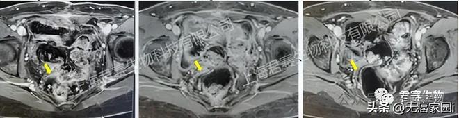 370万天价疗法将被颠覆？国研TIL最快2027年上市惠及实体瘤患者(图3)