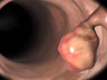 别等肠镜结果出来再后悔！今天开始守住你的三道“防癌线”(图4)